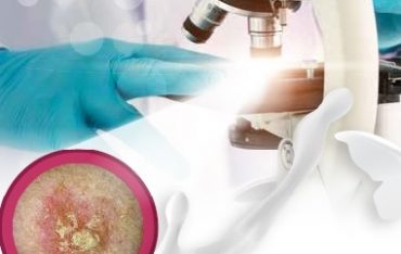 Actinic Keratosis - scripted patients only
