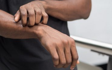 What is Ringworm?